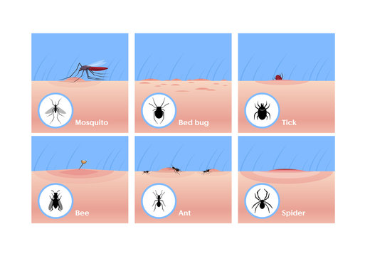 Insect bites flat vector illustrations set. Mosquito drinking blood, tick getting under skin, bee sting. Bed bug, ant and spider bites. Skin lesion, wound and inflammation, allergic reaction.