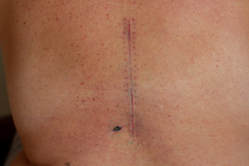 Fototapeta premium scar on the spine of a person from surgery