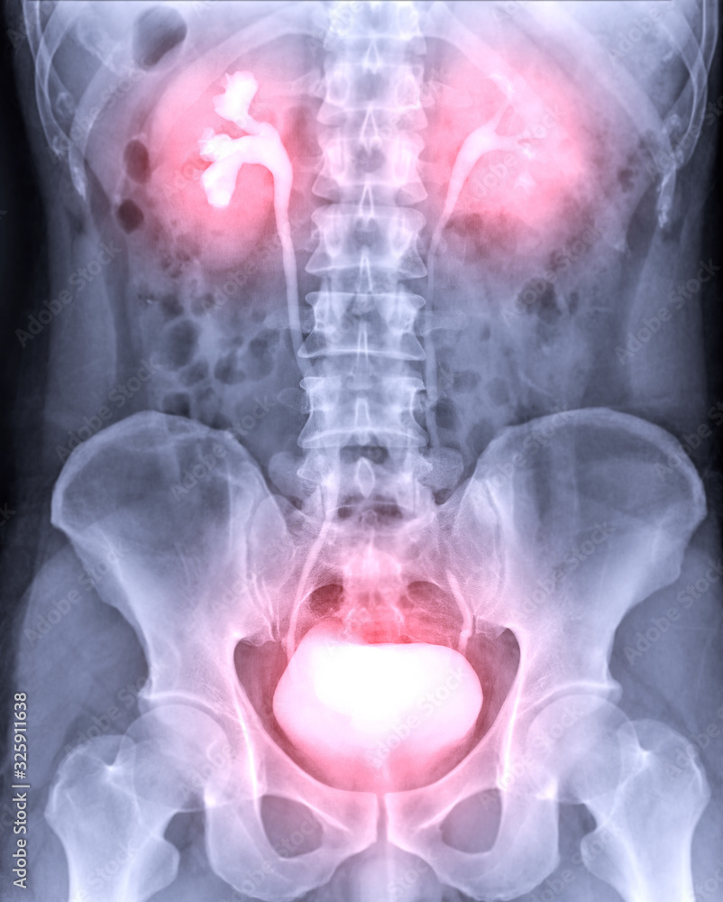 Aufkleber intravenous pyelogram or i.v.p is an x-ray exam of urinary tract after injection contrast media agen