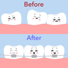 The concept of orthodontic treatment. Distorted teeth Before and straight teeth with braces After. Vector illustration