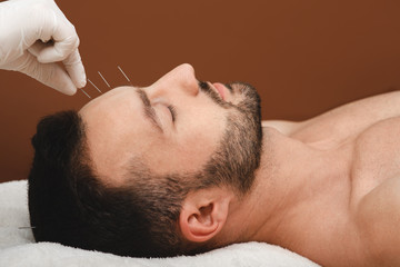 Acupuncture treatment for man headache and migraine. Closeup acupuncture needles in a man's...