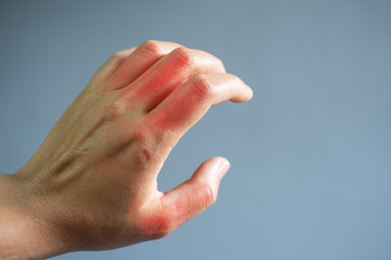 Close up hand painful in gout patient.