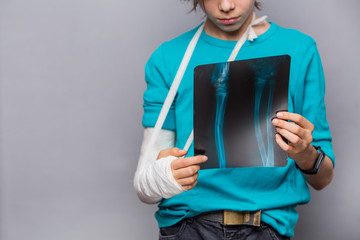 Sad handsome boy with broken arm holding his z -ray image, looking on broken bones