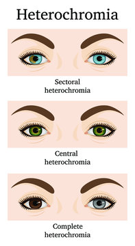Illustration of three types of heterochromia - partial, central and complete