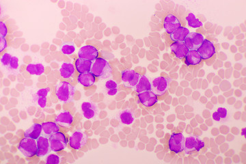 Acute promyelocytic leukemia cells or APL, analyze by microscope, original magnification 1000x