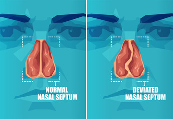 Vector cross section of face with deviated and normal nasal septum - obrazy, fototapety, plakaty