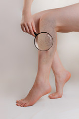 Medicine and health. The concept of female varicose veins. The woman holds a magnifying glass and...