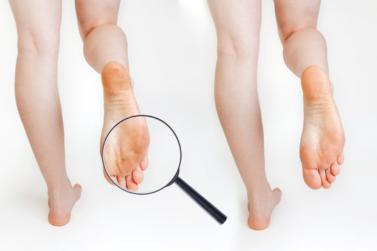 Female feet with dry corn and calluses, on a white background. Leg close-up. Magnified image of skin lesions through a magnifying glass. Cosmetology and medicine. Before and after concept