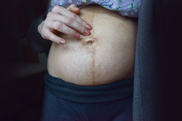 postpartum woman checking diastasis on stretch marked belly