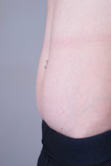 one of the stages of postpartum excess growth of adipose tissue and skin of the abdomen, after...