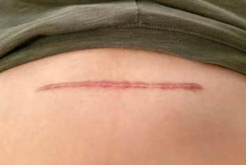 Close up cesarean section scar on woman belly. - obrazy, fototapety, plakaty