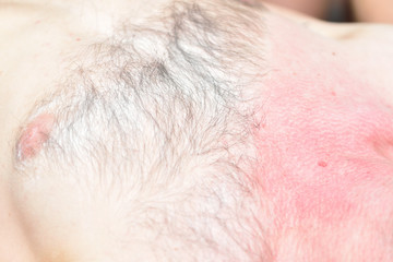 Red skin after depilation with black wax on the male body. close-up