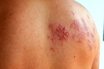 Fototapeta premium Shingles (Disease),Herpes zoster, severe dermatitis due to a viral infection and blisters on body