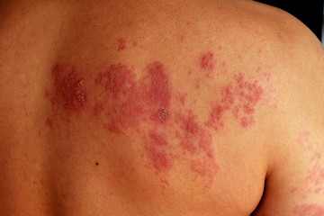 Shingles (Disease),Herpes zoster, severe dermatitis due to a viral infection and blisters on body