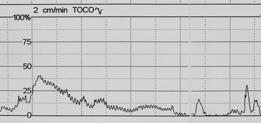 ecg graph, electrocardiogram ekg on paper