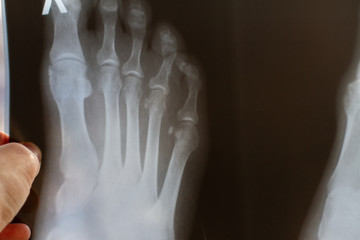 doctor holds an x-ray of a foot with a broken toe in his hand