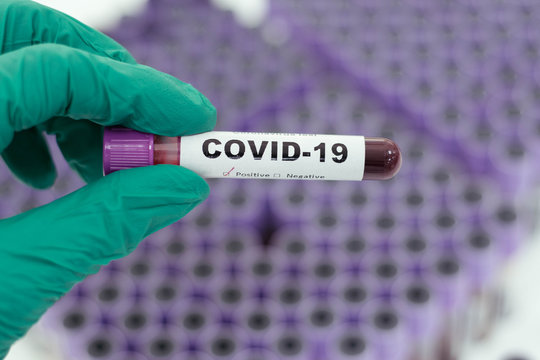 Laboratory Technician Hand Hold On Blood Sample Tube For Corona Virus Test , COVID 19 Test  