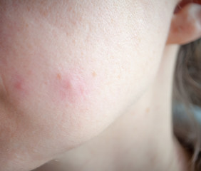 Fototapeta premium Inflammation of the female face, acne, female hormones and skin