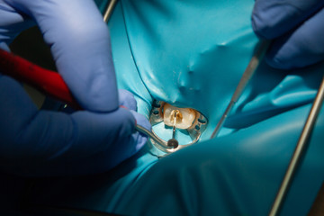 Treatment of dental canals in the upper molar permanent molar using an apex locator file, a tooth...