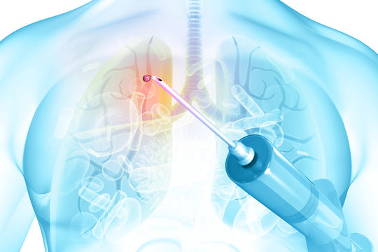 Human lungs with medicine syringe. 3d illustration.