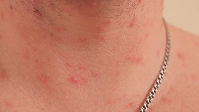 Close-up of chicken pox on the neck and chest of an adult male. Man is chickenpox, he problematic skin and scars from acne.
