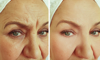 face old woman wrinkles before and after treatment