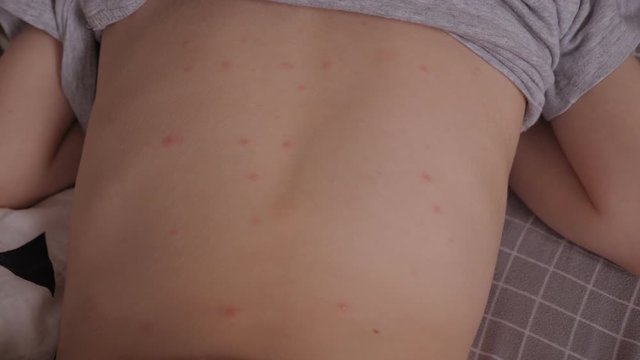 A little boy with chickenpox is lying on a bed at home. The child has a lot of blisters and smallpox from chickenpox on the skin.