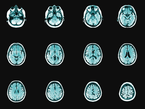 Human head and brain computer tomography image set. Horizontal partition of medical examining or anatomy study