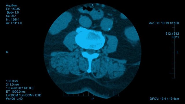 Spine computer tomography result visualization. Horizontal slides of spinal disk screening