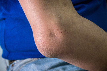 Right elbow with cellulitis