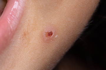 Scar near the cheek following the appearance of a pustule