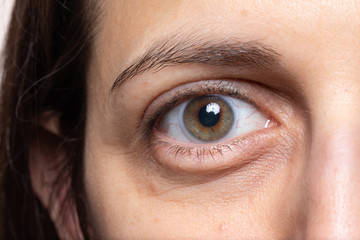 Macro of bags under the eyes, a sign of tiredness and physical exhaustion