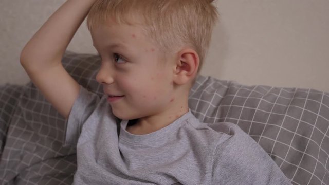 A little boy with chickenpox is lying in bed and scratching the skin on his face. Itching on the child's skin from red inflamed blisters from chickenpox.