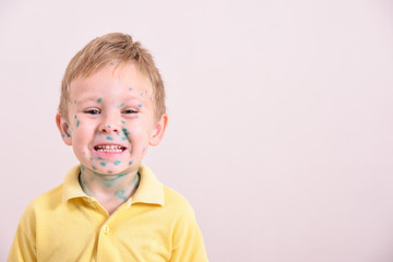 Young toddler,boy with chickenpox. Sick child with chickenpox. Varicella virus or Chickenpox bubble...