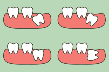type of wisdom tooth affect to other teeth - dental cartoon vector flat style