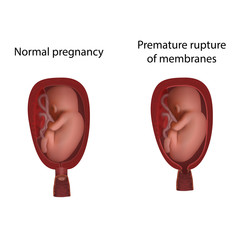 Normal and premature rupture of membranes. Cervical weakness. Fetus in uterus, womb, placenta, umbilical cord. Hi-risk pregnancy complications. Medical anatomy illustration.