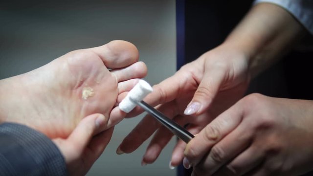 Doctor burns and freezes roots on the patient's foot that is infected with corn