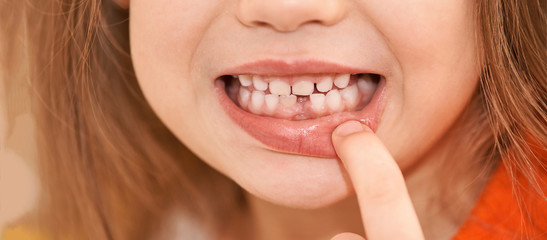 Young girl point on milk tooth. Baby losing teeth. Close up bath fenale portrait. Missing. Kid mouth gap. Smiling person. Childhood daily dental clean