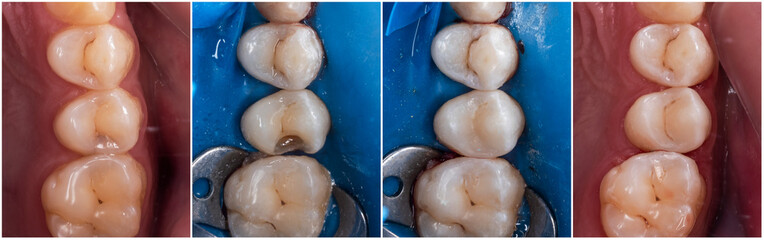 treatment of caries cavity step by step