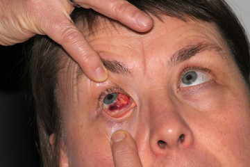 Bluterguss im Auge