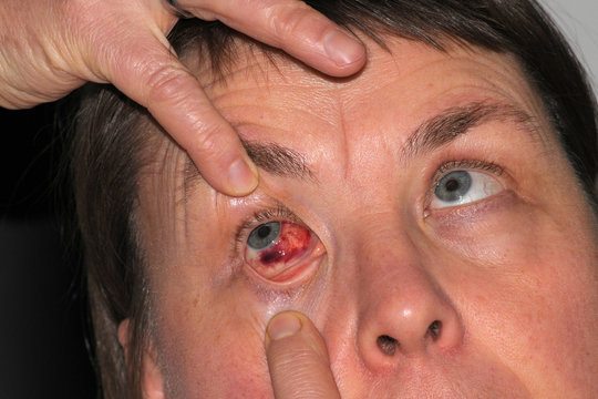 Bluterguss im Auge