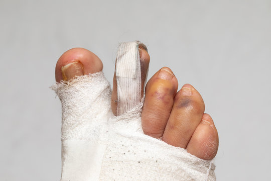 Post-operative correction of hallux valgus, details of bandaged fingers