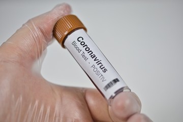 2019-nCoV Coronavirus. Positive blood sample held in one hand with laboratory glove. Respiratory...
