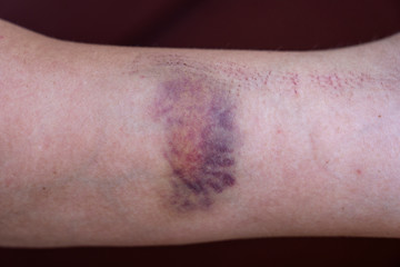 Purple bruise on the skin on a woman hand