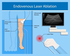 endovenous laser treatment CVD treat ELT legs inject EVLT varicose veins Radiofrequency Ablation RFA - obrazy, fototapety, plakaty