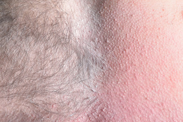 Male depilation. Half of male chest without hair after waxing. Close-up