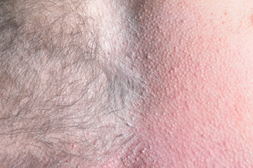 Fototapeta premium Male depilation. Half of male chest without hair after waxing. Close-up
