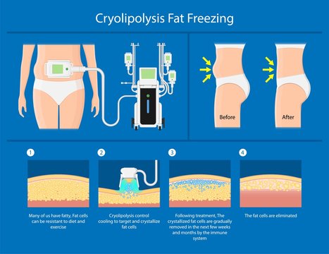 Cryolipolysis Fat Freezing Procedure Cold Treatment Non Invasive Medication Reduce Temperature Break Down Fat Cells Removal Cosmetic Surgery Adipose  Liposuction Coolsculpting