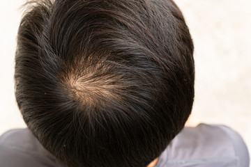 Top view of young Asiian bald man with dandruff.