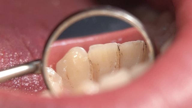 stomatology. reflection in a round dental mirror of a patient's teeth with tartar and plaque, extremely close-up. examination of diseased teeth by a dentist. teeth before brushing and whitening